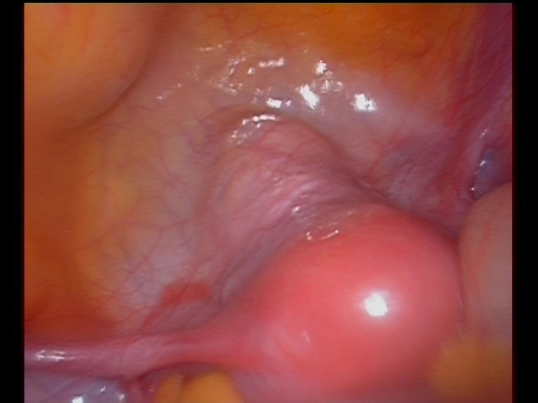 utero-vesical-pouch-front-of-uterus utero-vesical-pouch-front-of-uterus